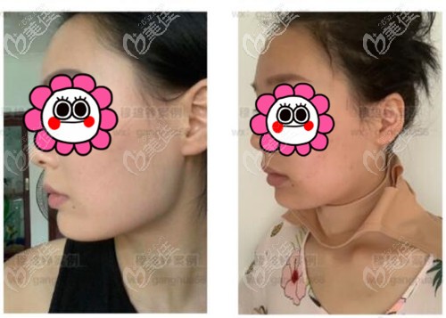 穆雄铮下颌角手术案例 穆雄铮下颌角手术案例