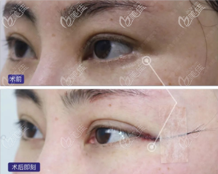 三张外眼角修复手术前后对比图一眼就能看出开外眼角能开多大