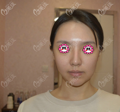 做面部埋线提升前 做面部埋线提升前