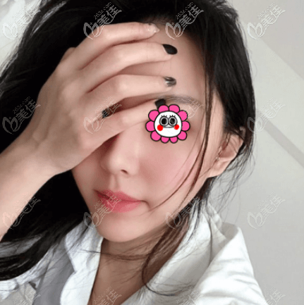 杜宁面部埋线提升案例效果 杜宁面部埋线提升案例效果