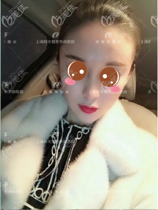 <!--<i data=20240703-sp></i>-->时光许黎平自体脂肪面部填充案例术后十五天