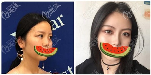 谭立文隆鼻手术案例