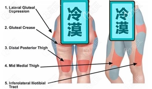 大腿环吸抽脂部位分布图