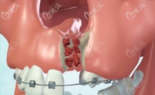 牙槽骨突裂植骨手术的原理 牙槽骨突裂植骨手术的原理