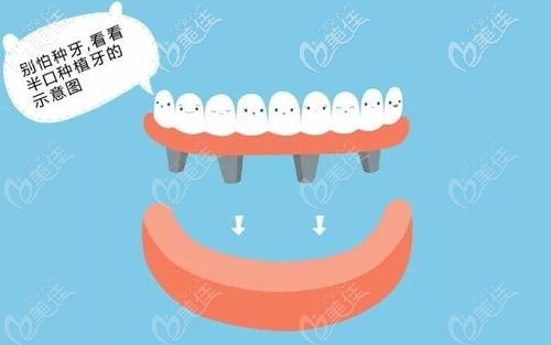 半口种植牙的示意图 半口种植牙的示意图