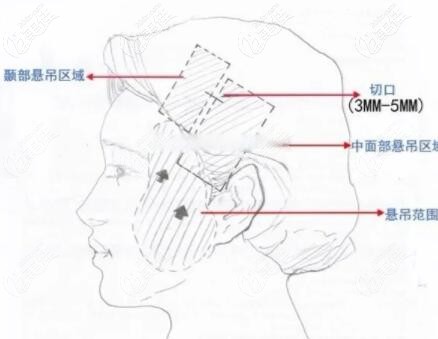 小拉皮切口部位示意图
