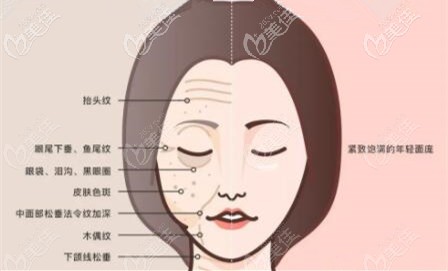 抗衰除皱做拉皮手术多久能恢复好