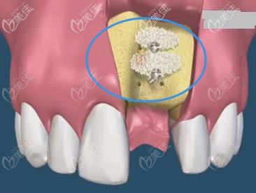 牙槽骨植入骨粉的示意图