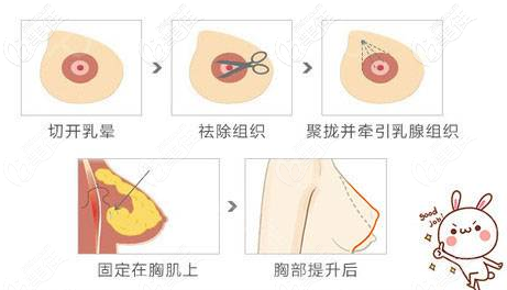 双环法乳房提升手术切口