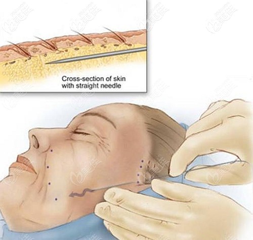 张年翁医生做全脸埋线提升的优势