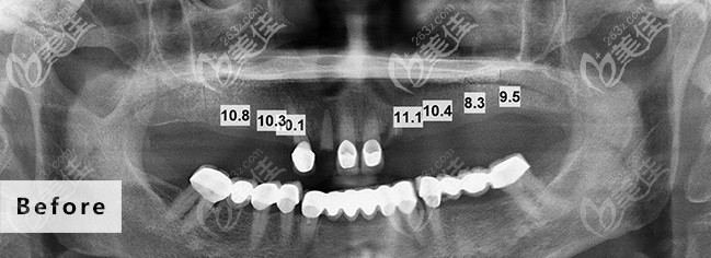 没种牙时候的样子 没种牙时候的样子