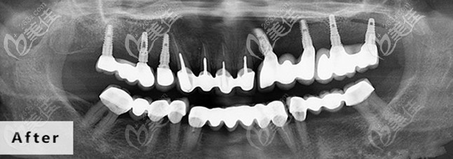 上半口牙缺牙后选择植入7颗种植体完成修复,费用不高效果还好！