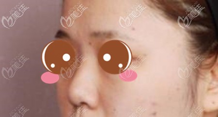 没到南阳集美整形隆鼻前 没到南阳集美整形隆鼻前