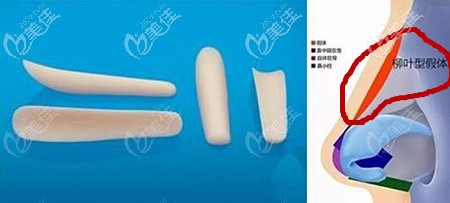 柳叶型假体隆鼻的利弊 柳叶型假体隆鼻的利弊