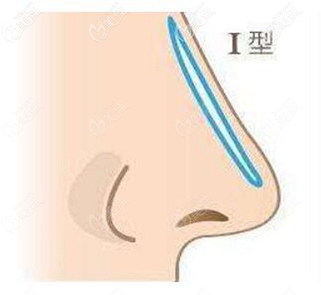 I型假体隆鼻的优缺点 I型假体隆鼻的优缺点