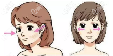 一针降颧骨颧弓