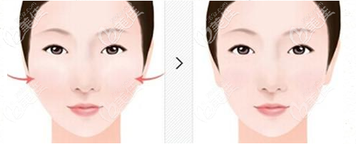 一针降颧骨颧弓会导致脸下垂吗？