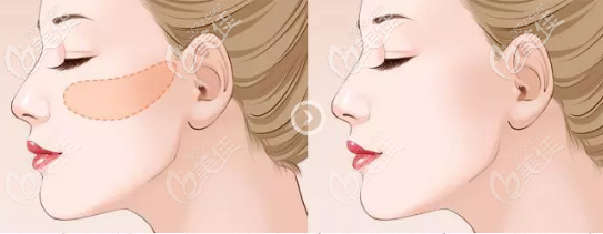 一针降颧骨颧弓能够降低多少毫米