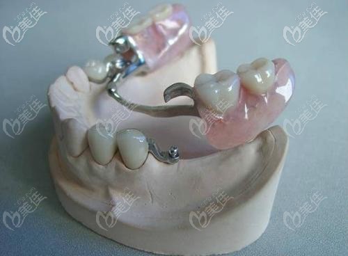 挂钩假牙的外观 挂钩假牙的外观