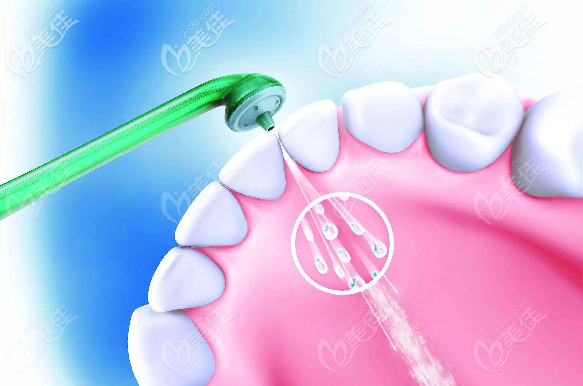 超声波洁牙示意图 超声波洁牙示意图