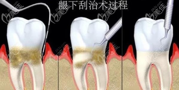 牙周洁治术示意图 牙周洁治术示意图