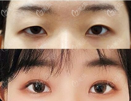 在韩国优雅人做眼综合术前术后对比照