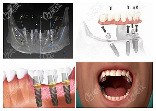 鑫西华口腔种牙优势点