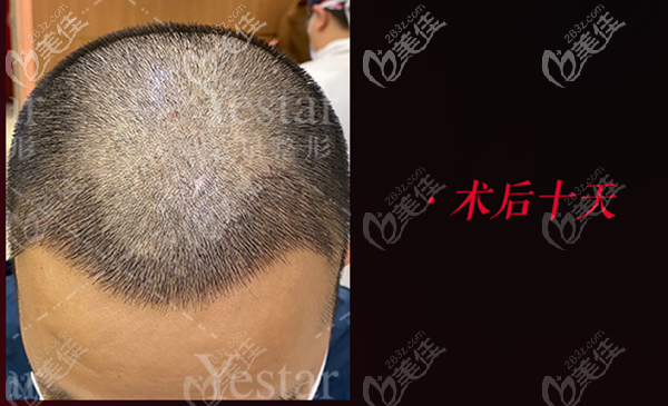 关于深圳艺星男士m型发际线植发案例及手术费多少钱等问题,今日开说...