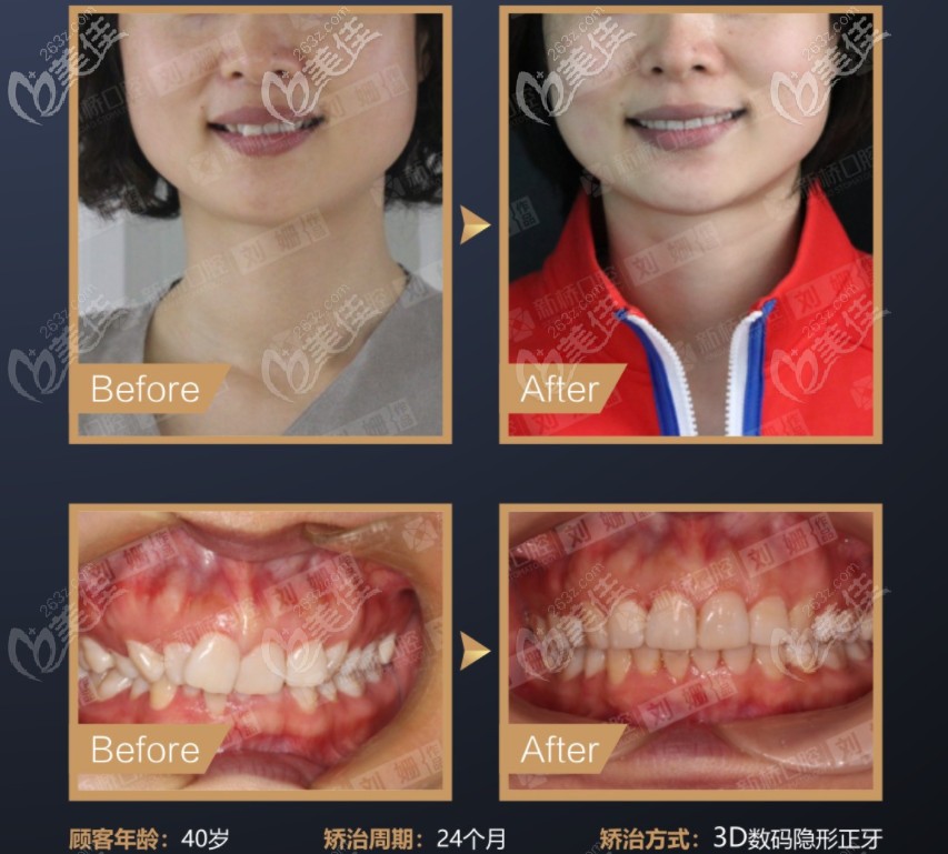 刘珊医生的矫正实例