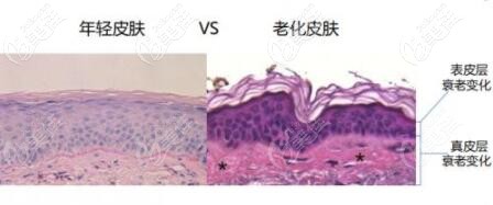 年轻皮肤与老化皮肤的对比示意图 年轻皮肤与老化皮肤的对比示意图