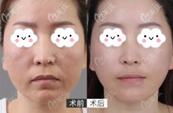 娃娃针平复口角纹真人前后对比照 娃娃针平复口角纹真人前后对比照