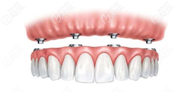 半口半固定种植 半口半固定种植