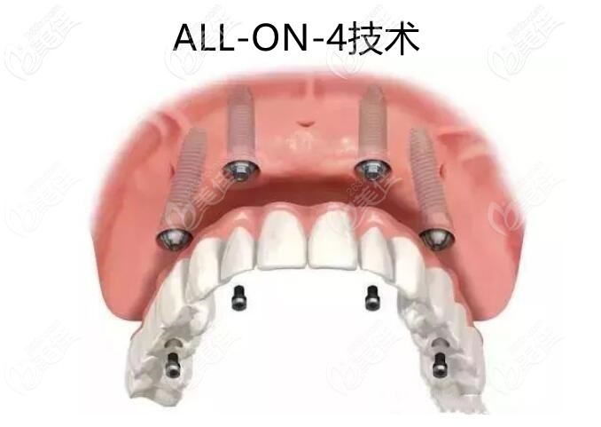 ALLON4导板种植技术 ALLON4导板种植技术
