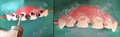 乳牙龋齿做牙冠的好处