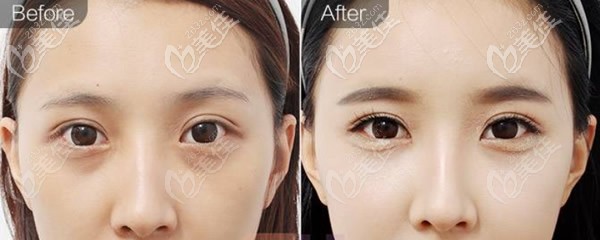 卧蚕再造术3大方法优劣势对比玻尿酸自体脂肪和人工真皮丰卧蚕哪个