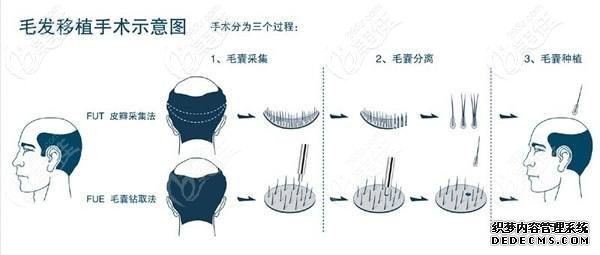 荆州华美植发科植发手术过程