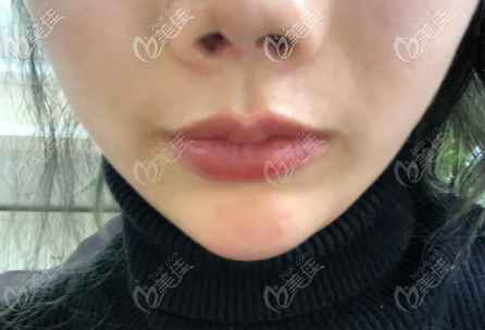 挛缩鼻修复后再次感染取出假体后鼻子会继续挛缩吗