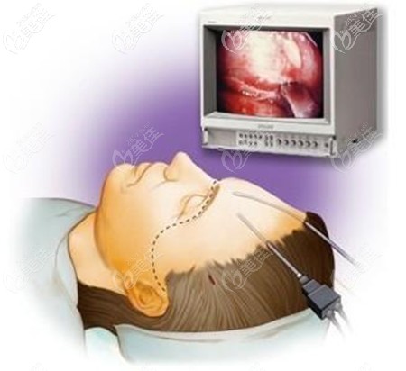 内窥镜拉皮除皱手术 内窥镜拉皮除皱手术