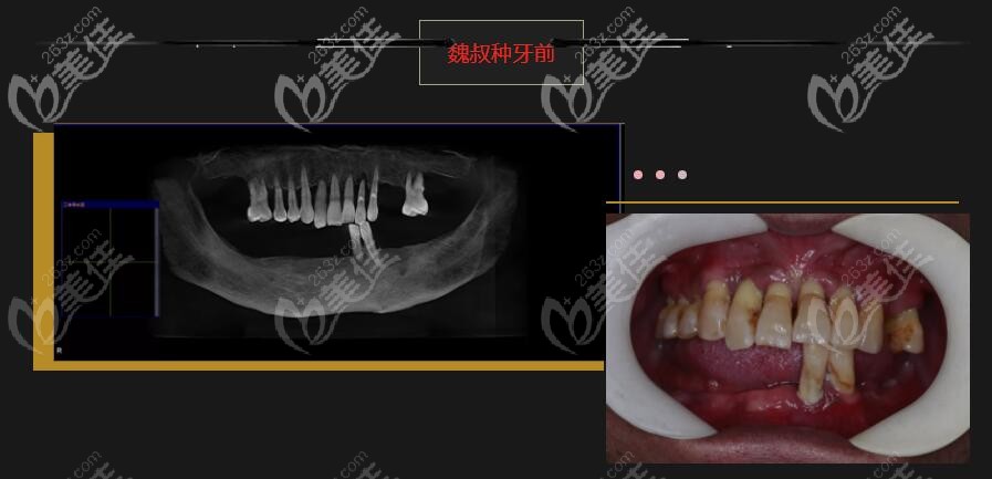 牙龈重度萎缩的65岁老人在柏德口腔做全口alllon6种植牙案例分享