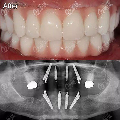 70岁老人在北京瑞泰口腔丰台医院用4颗种植体解决了半口牙缺失