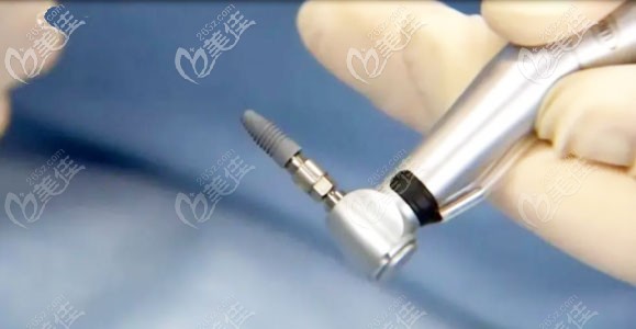 种植体外观展示图 种植体外观展示图