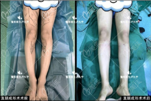 x型腿和o型腿矫正图片分析上海卢九宁直腿成形术费用多少并不重要