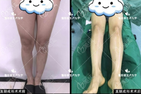 上海丽质卢九宁直腿成型术案例图3
