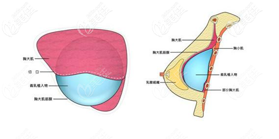 假体隆胸植入层次脂双平面植入