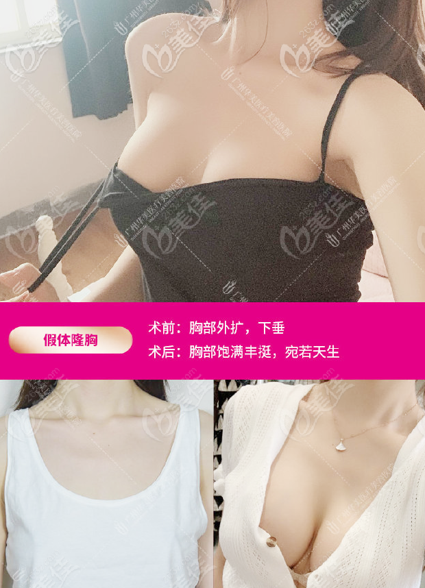 广州华美郝永生傲诺拉假体隆胸<span style=