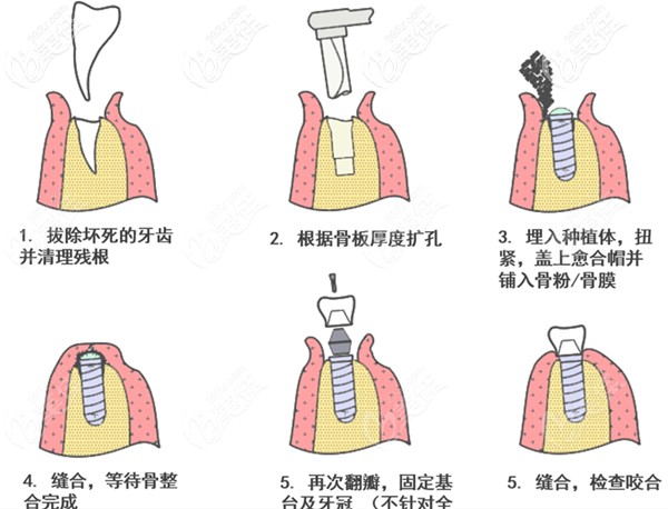 单颗牙齿种植的过程图