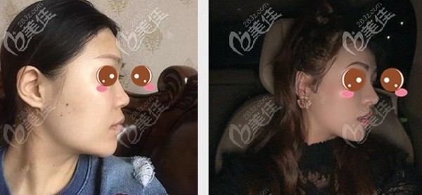 北京柏丽李劲良肋软骨隆鼻<span style= 北京柏丽李劲良肋软骨隆鼻<span style=