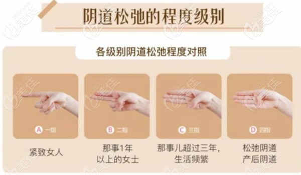 阴道松弛程度级别 阴道松弛程度级别