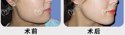 穆雄铮下颌角手术案例