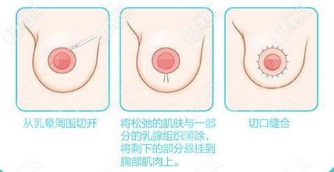 乳房双环悬吊提升手术步骤
